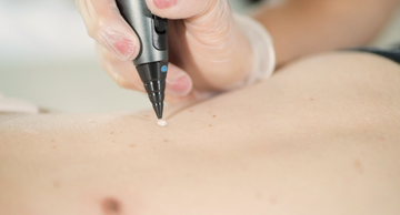 Cryotherapie - Besurgical